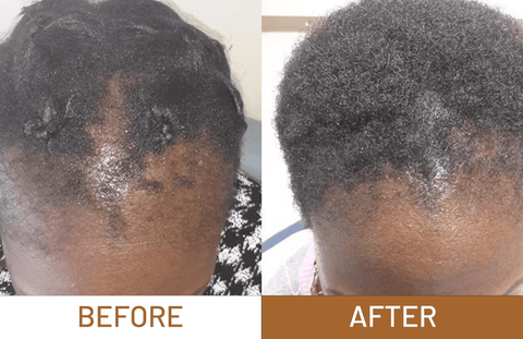 Batana Oil Pure Luxe Hair Boost Hair Growth Oil + Free Derma Roller