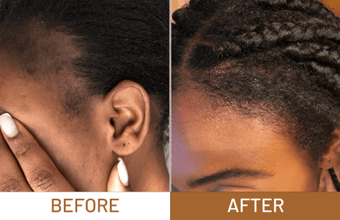 Batana Oil Pure Luxe Hair Boost Hair Growth Oil + Free Derma Roller