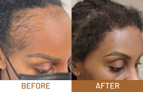 Batana Oil Pure Luxe Hair Boost Hair Growth Oil + Free Derma Roller