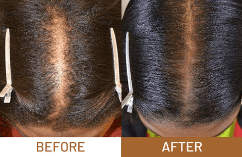 Batana Oil Pure Luxe Hair Boost Hair Growth Oil + Free Derma Roller