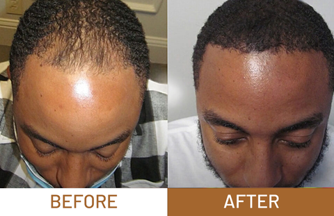 Batana Oil Pure Luxe Hair Boost Hair Growth Oil + Free Derma Roller