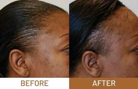 Batana Oil Pure Luxe Hair Boost Hair Growth Oil + Free Derma Roller
